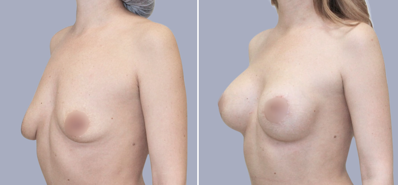 Фоторезультаты: подтяжка груди до и после изображение 1