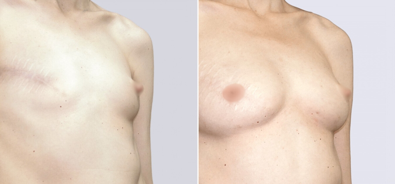 Липофилинг груди до и после изображение 1