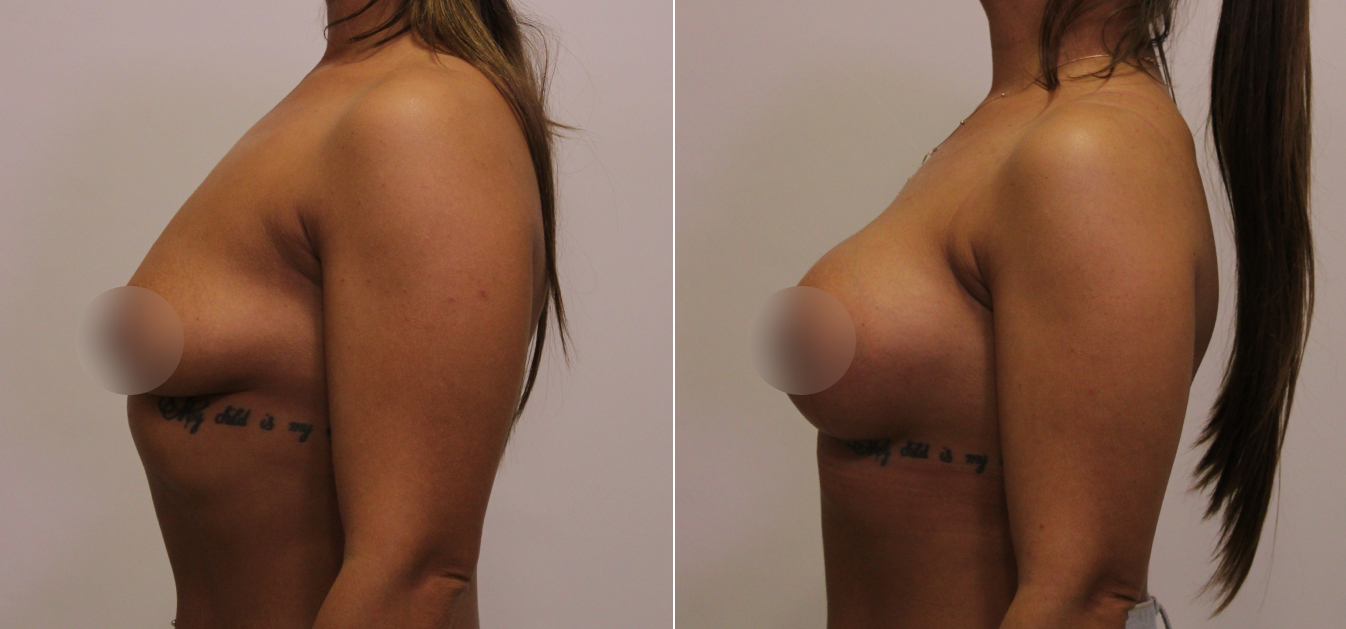 Фоторезультаты: увеличение груди до и после изображение 15