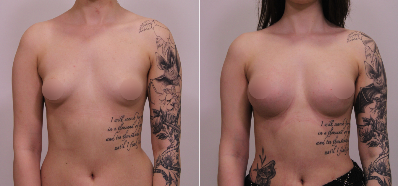 Фоторезультаты: увеличение груди до и после изображение 18