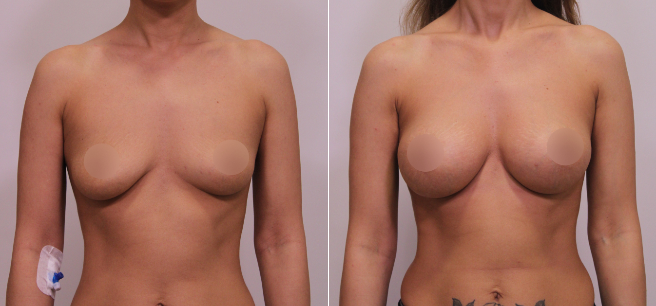 Фоторезультаты: увеличение груди до и после изображение 16