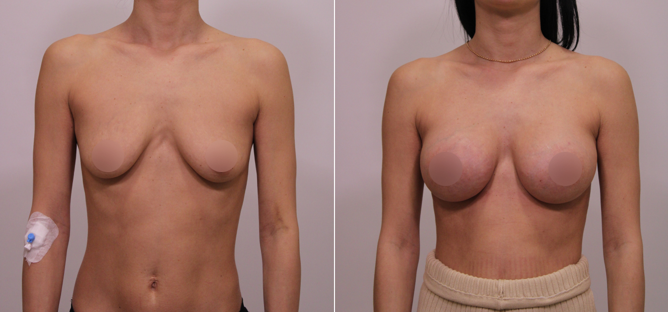 Фоторезультаты: увеличение груди до и после изображение 17