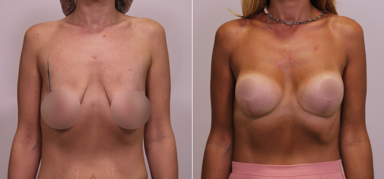 Фоторезультаты: увеличение груди до и после изображение 19