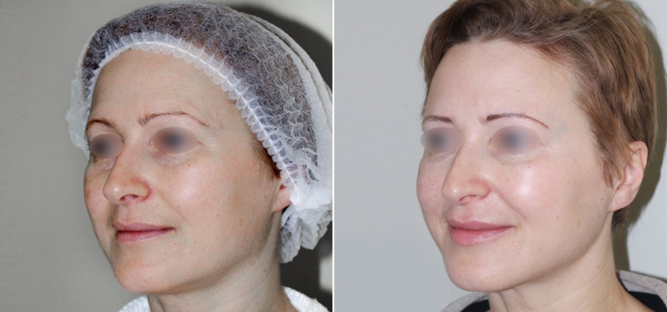 Лазерная подтяжка лица до и после изображение 6