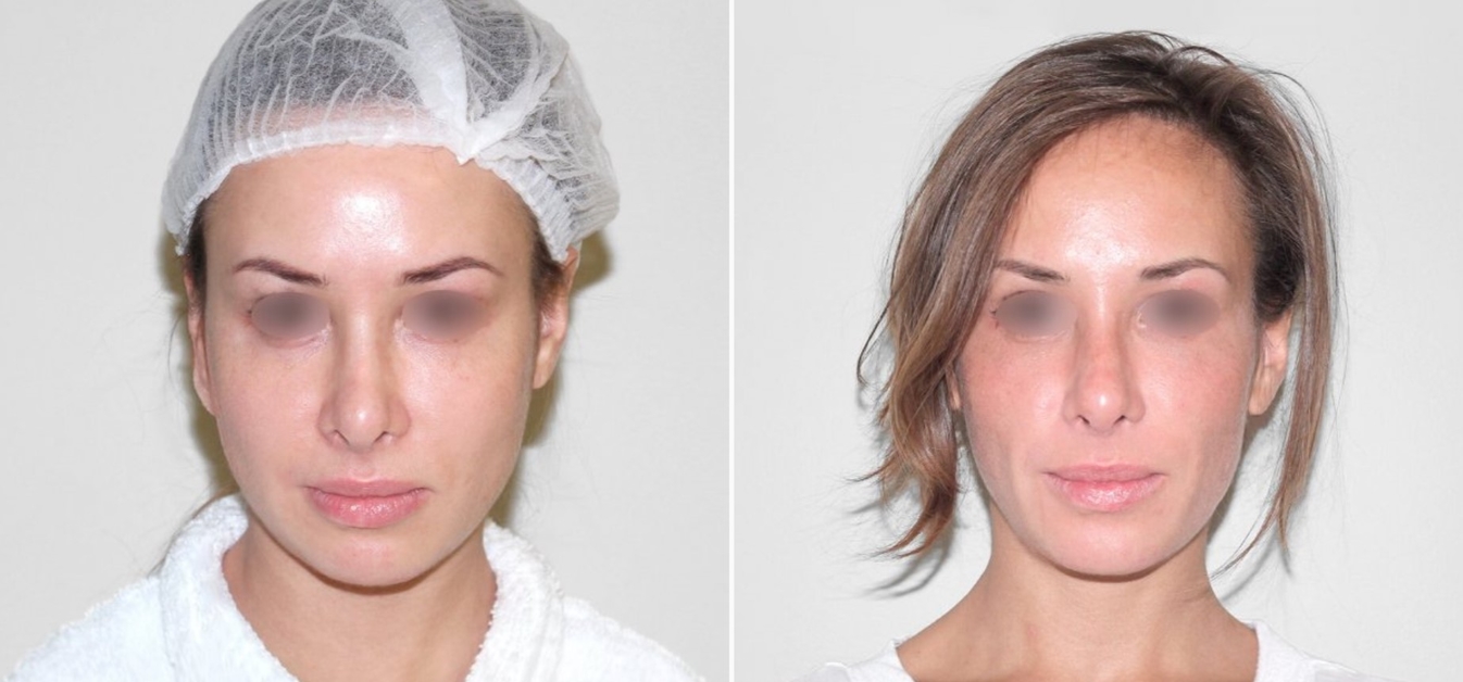 Лазерная подтяжка лица до и после изображение 1